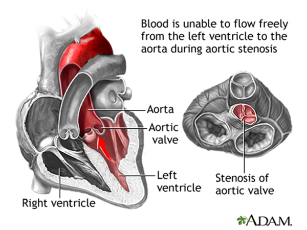 Study Examines Why Some Aortic Stenosis Patients Experience LV Failure ...