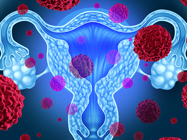 Hysterectomy with Ovarian Conservation Tied to CV Risks - Risk ...