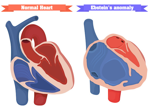 Prognostic Value of Right Ventricular Longitudinal Strain in Patients With  COVID-19