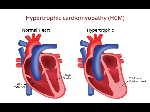 2 New RCTs Help Fill Gap for Hypertrophic Cardiomyopathy Therapies ...