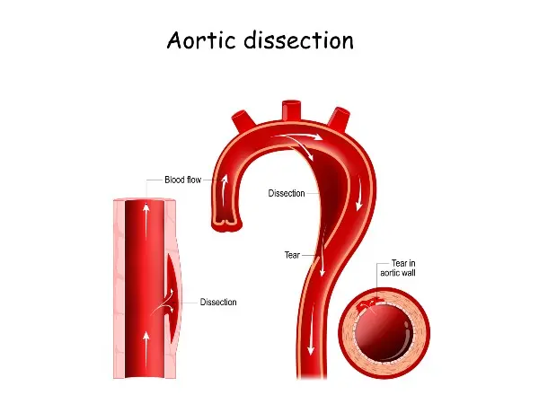 Genetic Variation in Heritable Thoracic Aortic Disease May Help ...