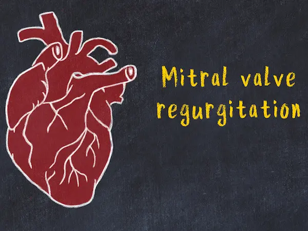 MitraClip or PASCAL Use in Mitral Valve TEER Success Comparable, Study ...