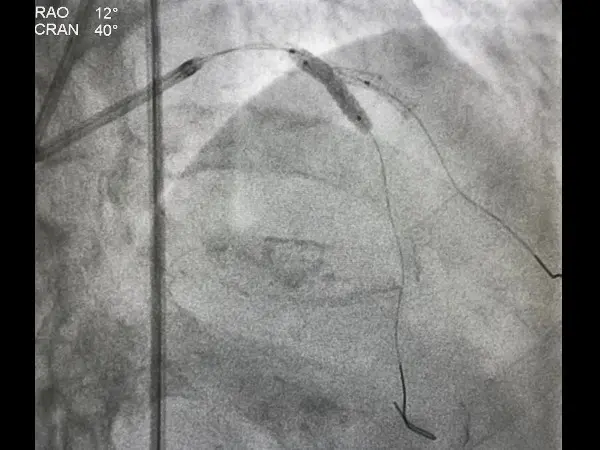 Two-Stent Approach Provides Benefit Over Provisional Stenting for ...