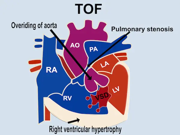 Hypoplastic Pulmonary Arteries Do Not Impact Outcomes In Neonates With 