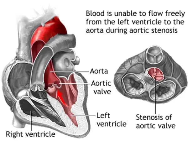 Asymptomatic Severe Aortic Stenosis Often Leads to Aortic Valve ...